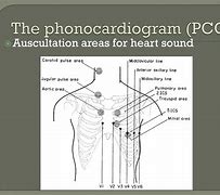 Image result for Normal Phonocardiogram