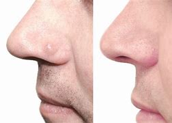 Image result for Mole or Wart On Nose