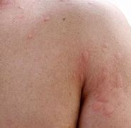 Image result for White Hives On Body