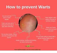Image result for Genital Warts Removal Kit