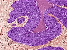 Image result for Brenner Tumor Ovary