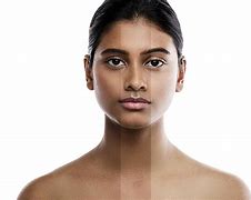 Image result for What Causes Your Face Melinan Fading