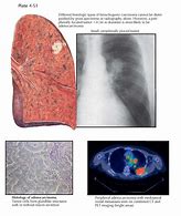 Image result for Lung Tumor Size