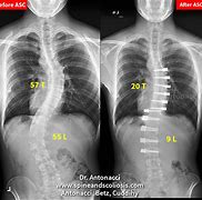 Image result for Severe Scoliosis Before and After