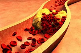 Image result for hiperlipidemia
