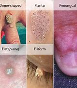 Image result for Common Wart Removal