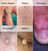 Image result for Flat vs Common Wart