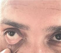 Image result for Pallor of Conjunctiva