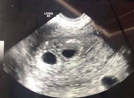 Image result for 5 Weeks Pregnant with Twins