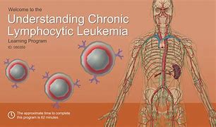 Image result for Symptoms of CLL Leukemia