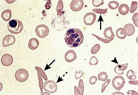 Image result for Sickle Cell Trait Blood Smear