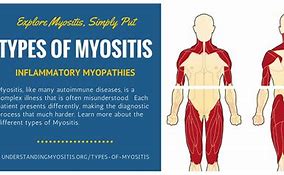 myositis 的图像结果