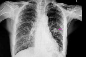 Image result for Lung Nodules On Chest X-Ray