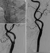 Image result for ICA Stent