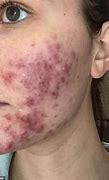 Image result for Bad Acne On Face
