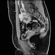 Image result for Dermoid Ovarian Mass