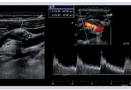 Image result for Carotid Doppler Ultrasound Stenosis