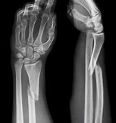 Image result for How Long Is 4 Inches On a Broken Arm