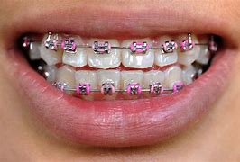 Image result for Braces Colors Pink