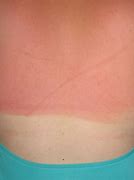Image result for Severe Sunburn