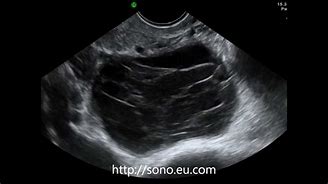 Image result for Hemorrhagic Cyst Ovary Ultrasound