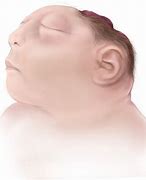 Image result for Fetal Death Anencephaly