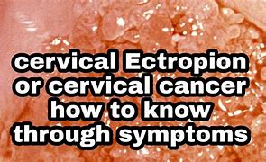 Image result for Cervical Ectropion