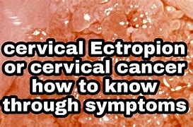Image result for Ectopy Cervix