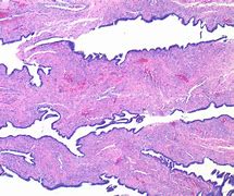 Image result for Serous Cystadenoma of Ovary