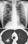 Image result for Solitary Pulmonary Nodule Biopsy