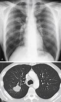 Image result for Solitary Pulmonary Nodule Lung Folow Up