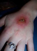 Image result for What Does an Infected Sore Look Like