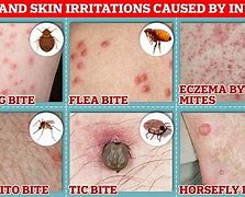 Image result for itch bugs signs