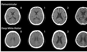 Image result for Fazekas CT Scan