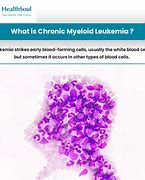 Image result for Chronic Myeloid Leukemia Symptoms