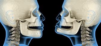 Image result for Jawbone Deterioration