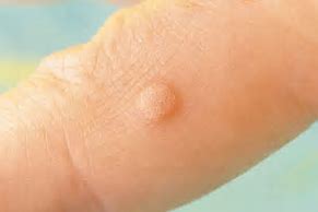 Image result for Wart On Elbow