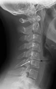 Image result for C-spine Radiculopathy