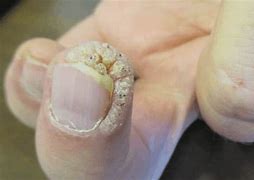 Image result for Periungual Wart Removal