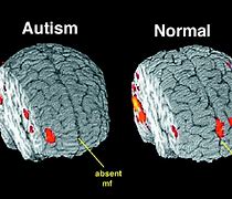 Image result for Autism Brain vs Normal