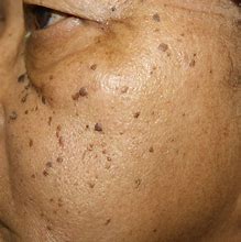 Image result for Dermatosis Papulosa Nigra
