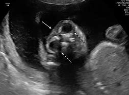 Image result for Anencephaly Ultrasound 3rd Trimester
