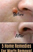 Image result for Best Treatment for Warts On Face