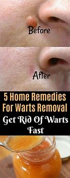 Image result for warts remove home remedy