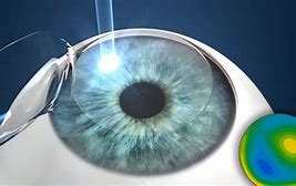 Image result for LASIK Eye Glimmer