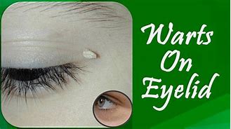 Image result for Treatment for Warts On Eyelids