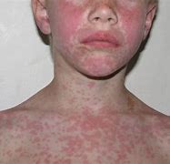Image result for Amoxicillin Allergy Rash