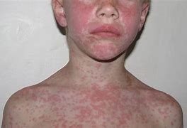 Image result for Allergic Reaction to Augmentin Rash