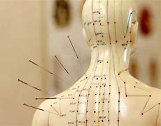 Image result for Acupuncture Healing