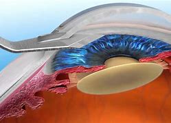 Image result for Laser Cataract Surgery